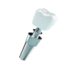 Dental Implants - Image 2